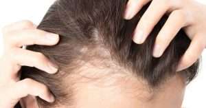 Hair Fall Solution in Pakistan, hair fall treatment