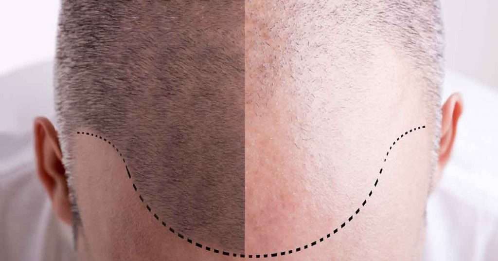 Hair Transplant surgeon in lahore , Hair Transplant solution in lahore