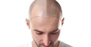 Hair Transplant under the best hair specialist in lahore