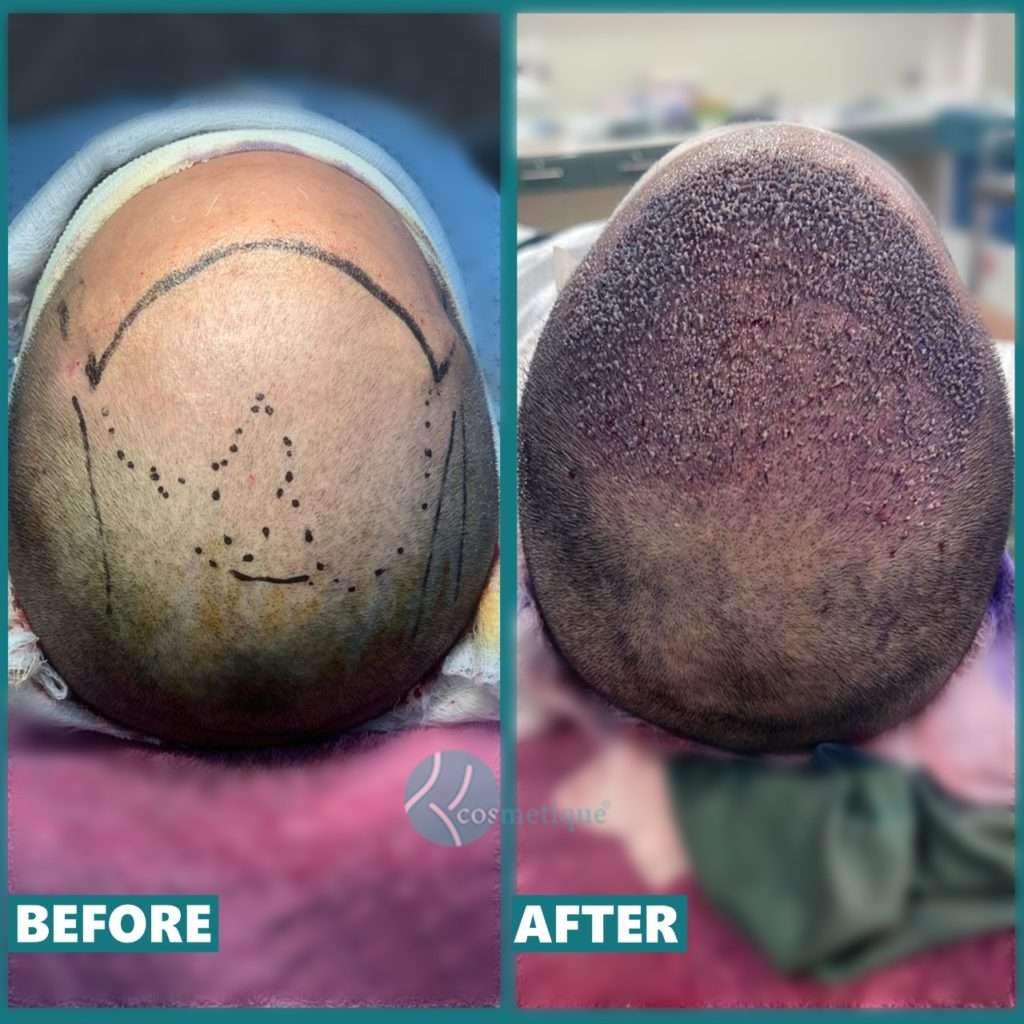 Hair Transplant Surgery in Lahore, before and after pic hair transplant