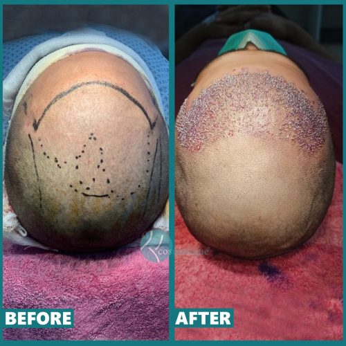 Hair Transplant Surgery in Lahoreclinic