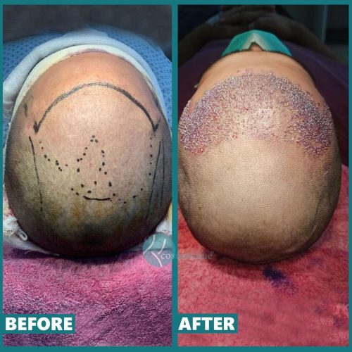 Hair Transplant Surgery in Lahore beforea nd after